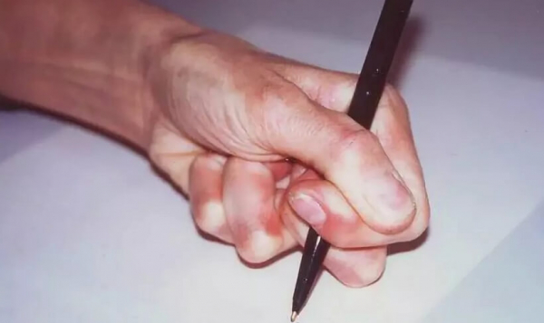 Дистония