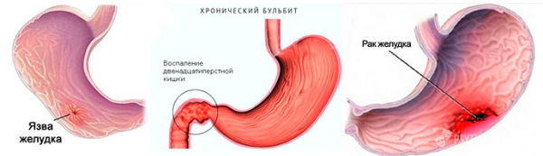 Ингибиторы протонной помпы при длительном применении могут привести к раку желудка